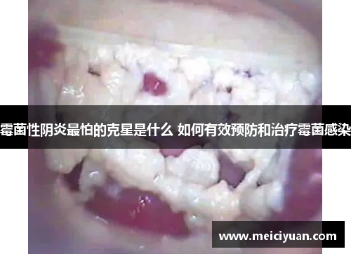 霉菌性阴炎最怕的克星是什么 如何有效预防和治疗霉菌感染