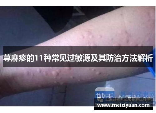 荨麻疹的11种常见过敏源及其防治方法解析 荨麻疹的11种常见过敏源及其防治方法解析